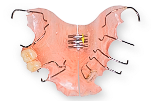Пластиночный расширяющий аппарат на верхнюю челюсть. В аппарате установлены искусственные зубы для замещения отсутсвующих у пациента.