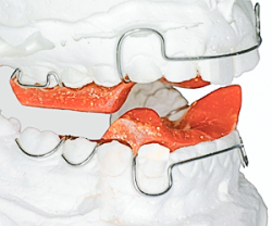 Аппарат Твин-блок: с помощью специальных выступов на пластинках со стороны жевательной поверхности зубов, закрытие рта возможно только при определенном положении нижней челюсти. Это приводит к активации роста нижней челюсти.