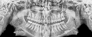 Ортопантомограмма (ОПТГ)-- панорамный снимок челюстей