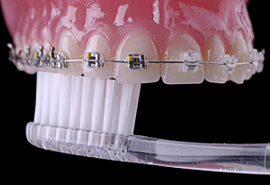 Чистка зубов ортодонтичекой щеткой